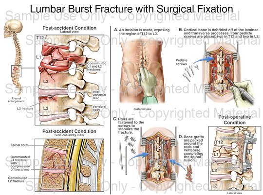 Burst Fracture