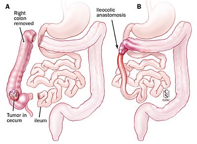 Right Hemicolectomy