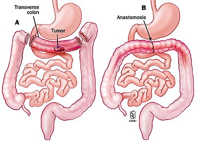 Transverse Colectomy