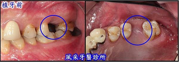 植牙前