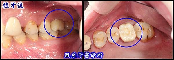 植牙後