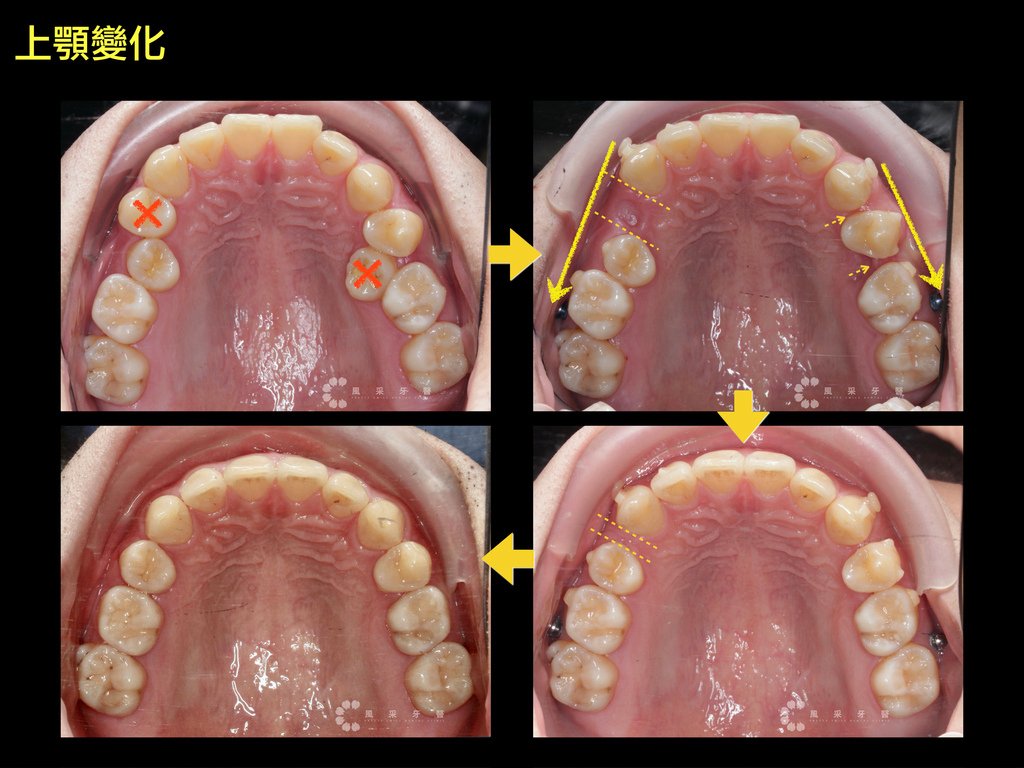 0841209陳弘育 網路行銷用 上顎變化.014.jpeg