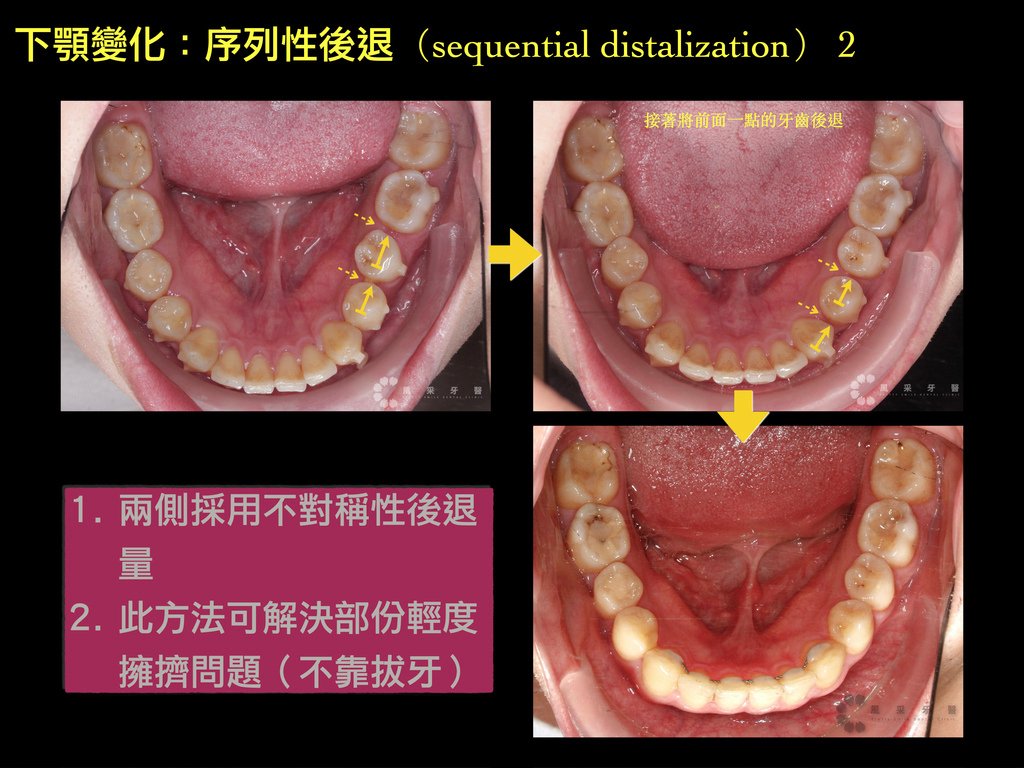 0841209陳弘育 網路行銷用 上顎變化.018.jpeg
