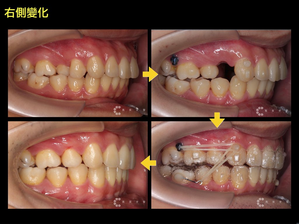 0841209陳弘育 網路行銷用 上顎變化.022.jpeg