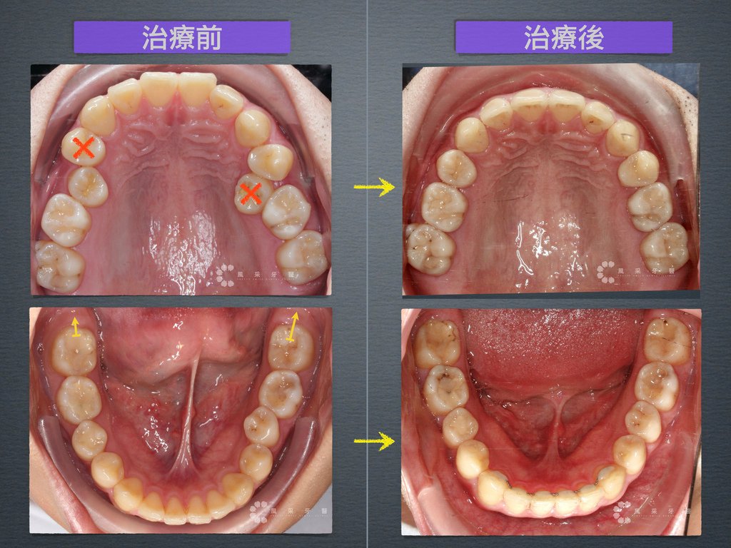 0841209陳弘育 網路行銷用 上顎變化.028.jpeg