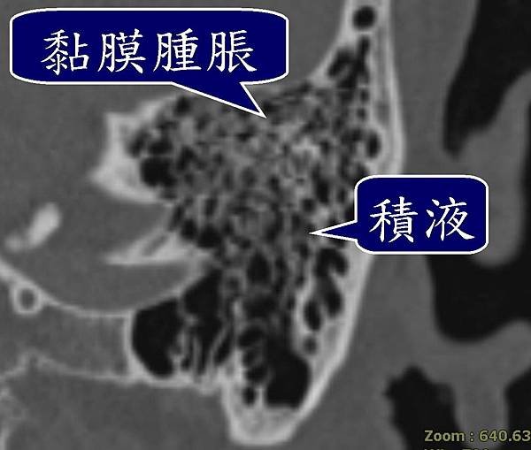 水生細菌感染性中耳炎 圖一.jpg