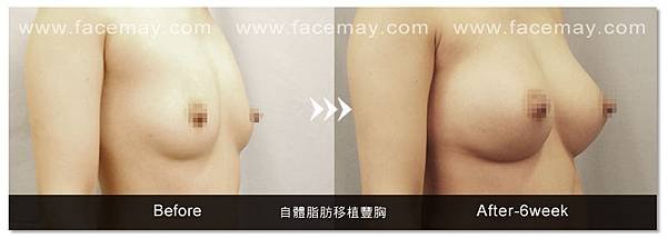 自體脂肪豐胸案例3.jpg