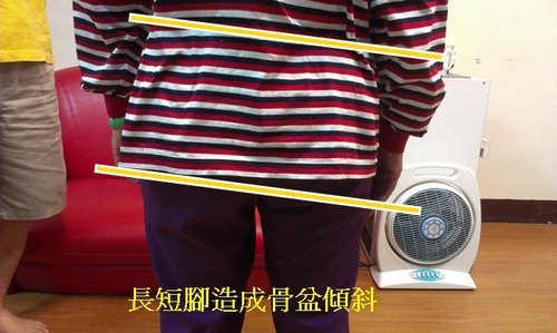 車禍開刀導致骨盆高低之長短腳鞋墊