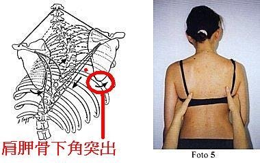 脊椎側彎的症狀：肩胛骨突出