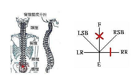 彎腰不會痛 在伸直過程時才會痛