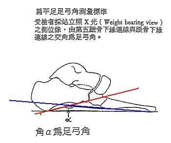 扁平足角度測量方法