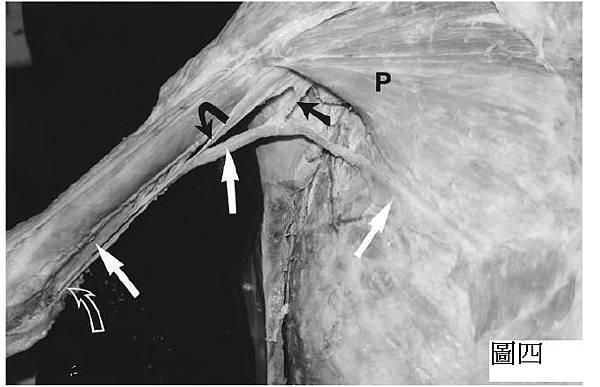 chondroepitrochlearis muscle