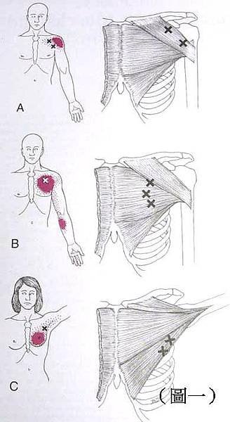 pectoralis Tr.p