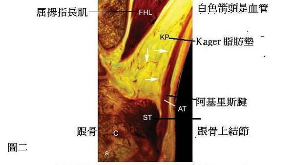 阿基里斯腱