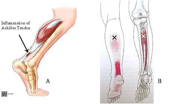 posterior tibialis Tr,P