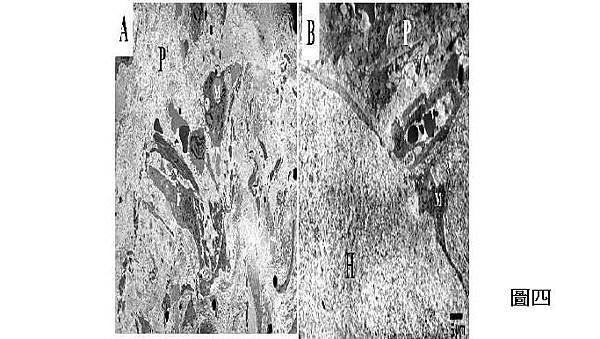 periradicular adhesion tissue 2