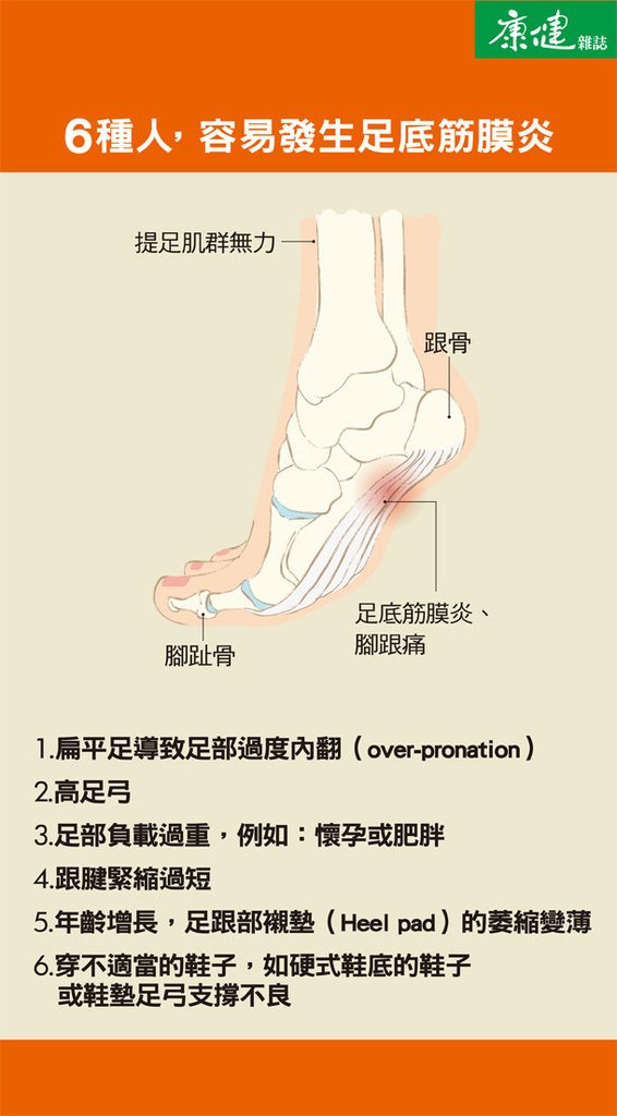 ６種人，容易發生足底筋膜炎