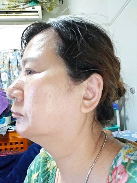 瘦臉 瘦下巴 臉浮腫 熱瑪吉   小潔 7