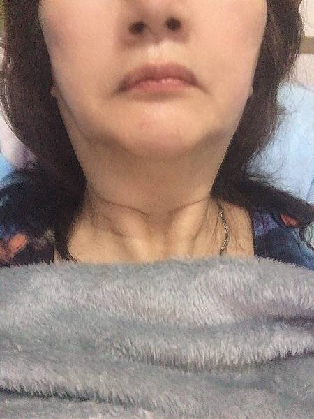 14 瘦雙下巴  小潔 14