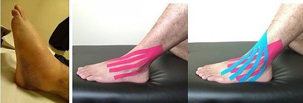 ankle swelling taping.jpg