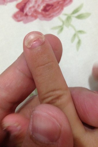 淇淇腸病毒掉指甲-06.jpg
