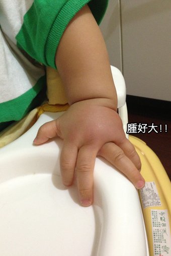 小宇蚊子咬會過敏-02.jpg