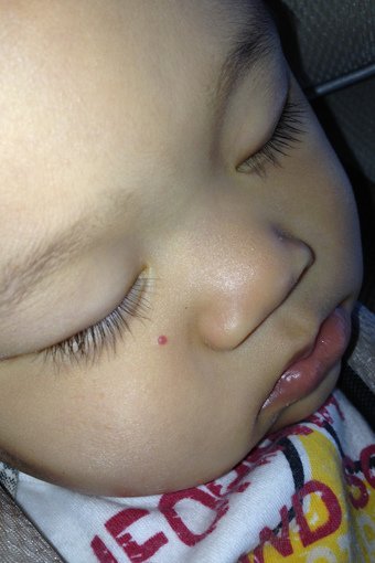 小宇1Y1M消失的血管瘤-02.jpg