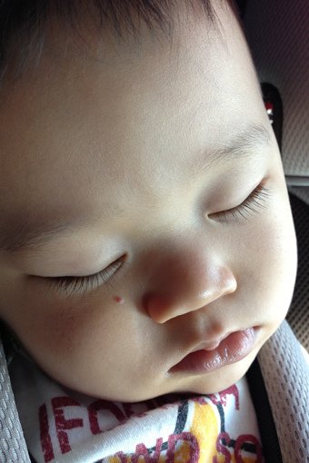 小宇1Y1M消失的血管瘤-03.jpg