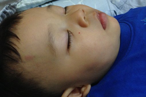 小宇1Y1M消失的血管瘤-04.jpg