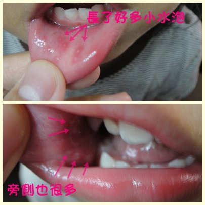腸病毒.jpg