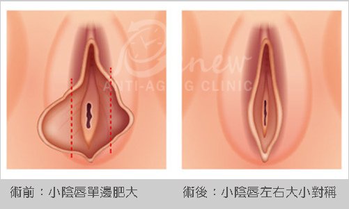 手術