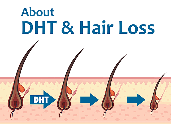 DHT %26; Hair Loss