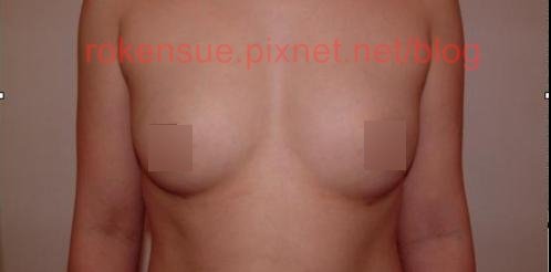 breast a1.jpg