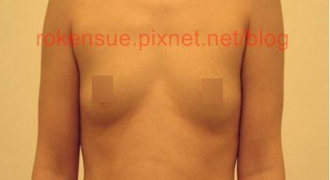 breast a.jpg