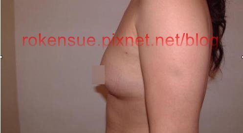 breast a3.jpg