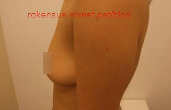 breast a6.jpg