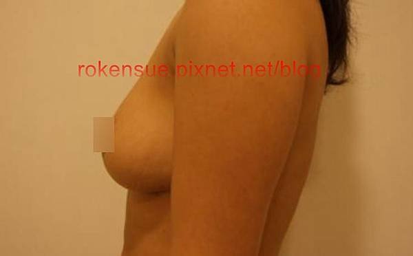 breast a7.jpg