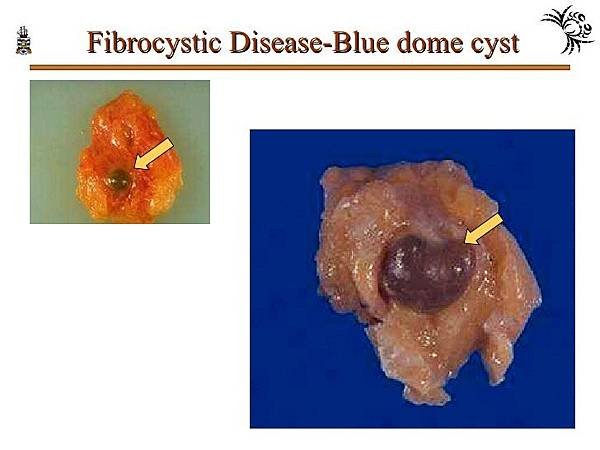 pathology-of-breast-disorders-29-728.jpg