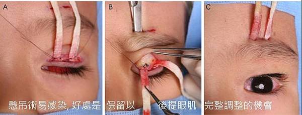 tarsal suspension1.jpg