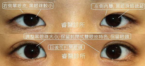 ptosis2-3.jpg