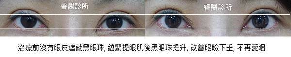 ptosis15-3.jpg