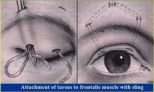 frontalis sling1.jpg