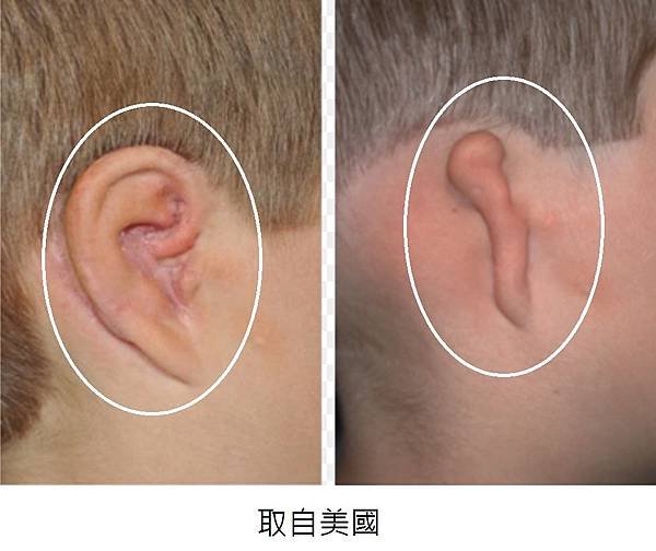 microtia3.jpg