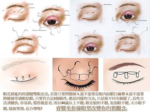 suture method4.jpg