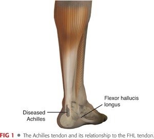 FHL Achilles tendons.jpg