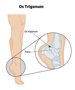 os trigonum syndorme.jpg