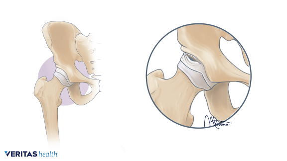 VA-70-Intra-articular-Tear.png