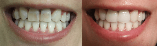 teeth white 2.png