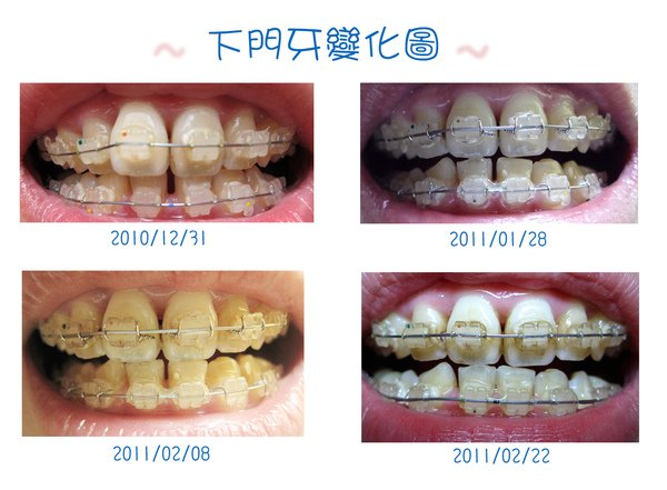 門牙變化圖2.jpg