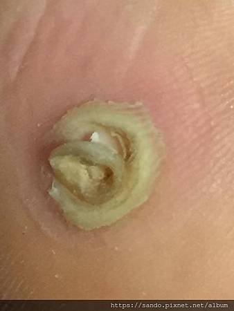 非常詳細記錄足底痊改善轉變痊癒照~謝謝